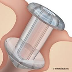 OASIS SOFT PLUG Silicone Punctal Plugs - Box of 6